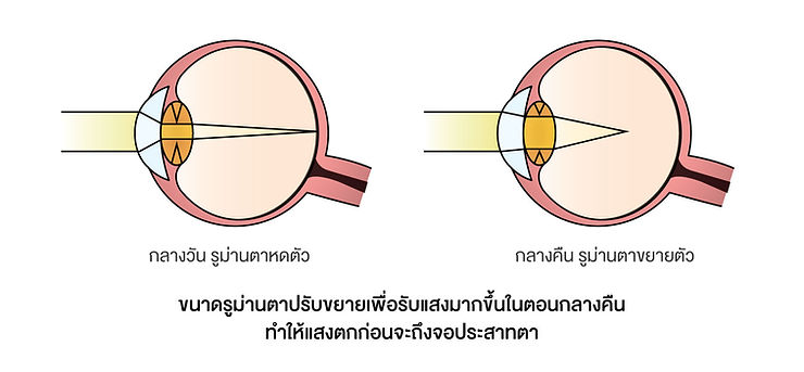 กลไกการเกิดภาวะสายตาสั้นตอนกลางคืน เมื่อขนาดรูม่านตาปรับขยายเพื่อรับแสงมากขึ้นในตอนกลางคืน ทำให้แสงตกก่อนจะถึงจอประสาทตา