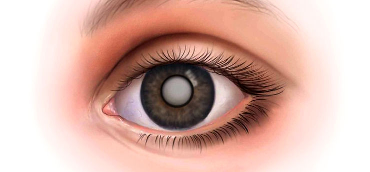 eye-close-up-cataract-illustration-740